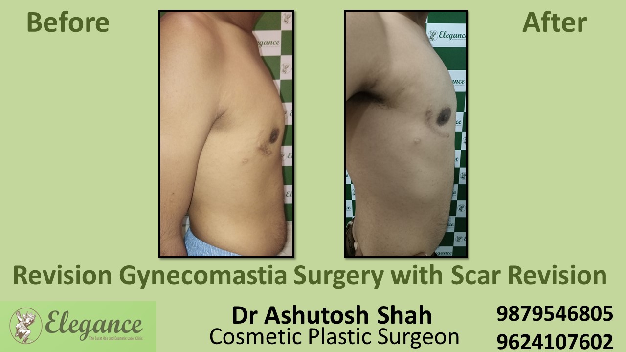 Best Revision Gynecomastia Treatment in Surat, Gujarat.