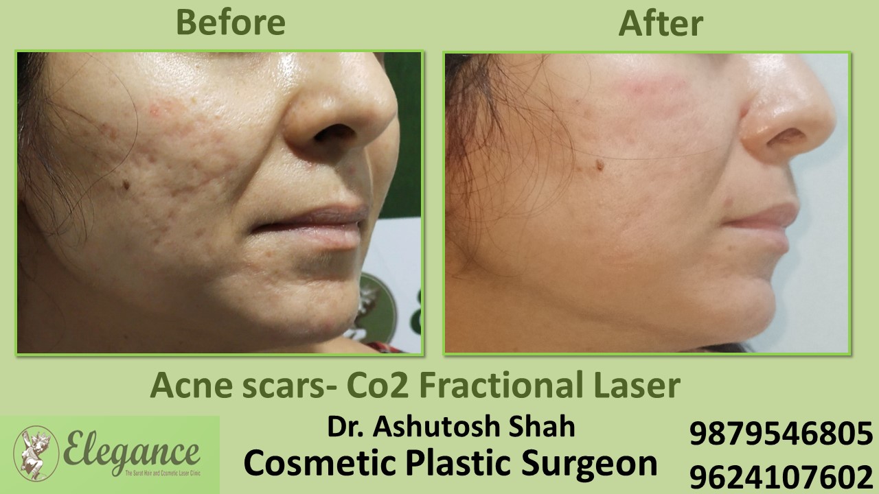 Best Treatment For Acne and Pigmentation in Surat, Valsad, Bharuch.