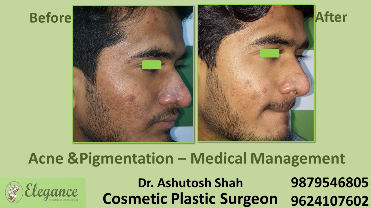 Best Treatment For pigmentation In Bamroli, Althan, Surat