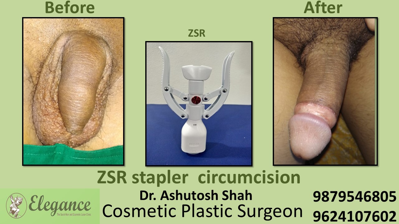 Best ZSR Stitchless Circumcision Surgery in Surat