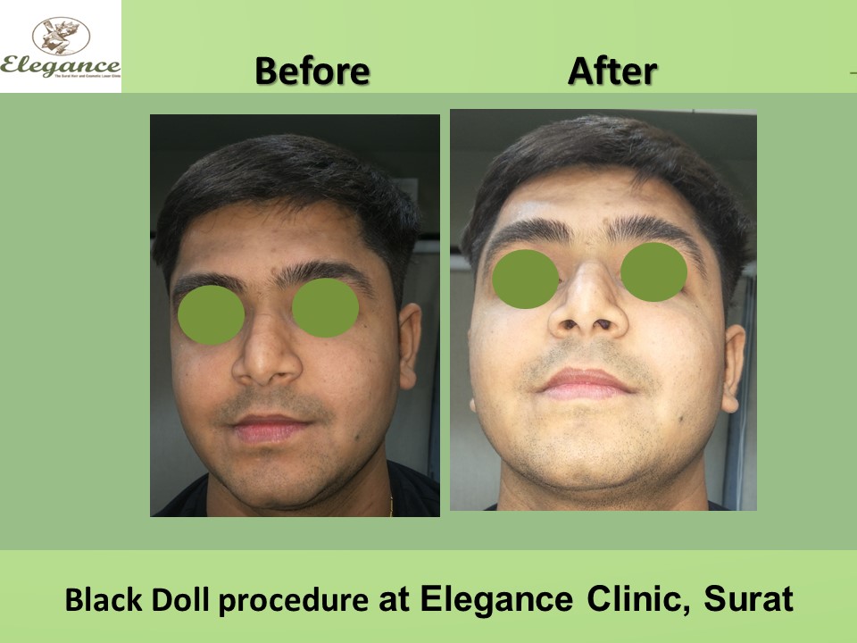 Black Doll Treatment in Face Makeover, Surat, Gujarat, India.