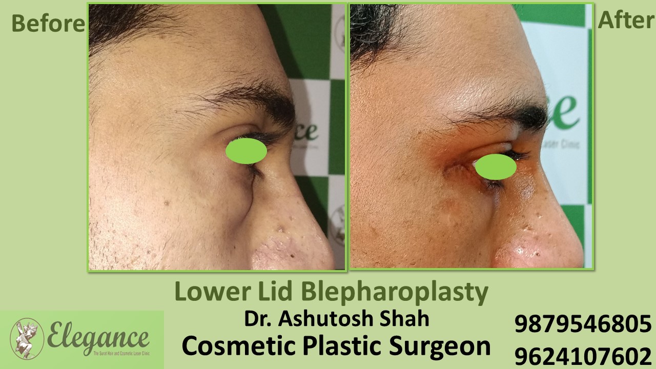 Blepharoplasty Best Clinic For Under Eye Treatment In Bharuch, Surat,  Navsari, Valsad.