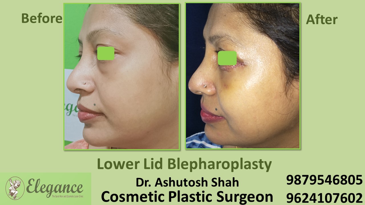 Blepharoplasty Best Clinic For  Eye Bags Treatment In Surat, Navsari, Vapi.