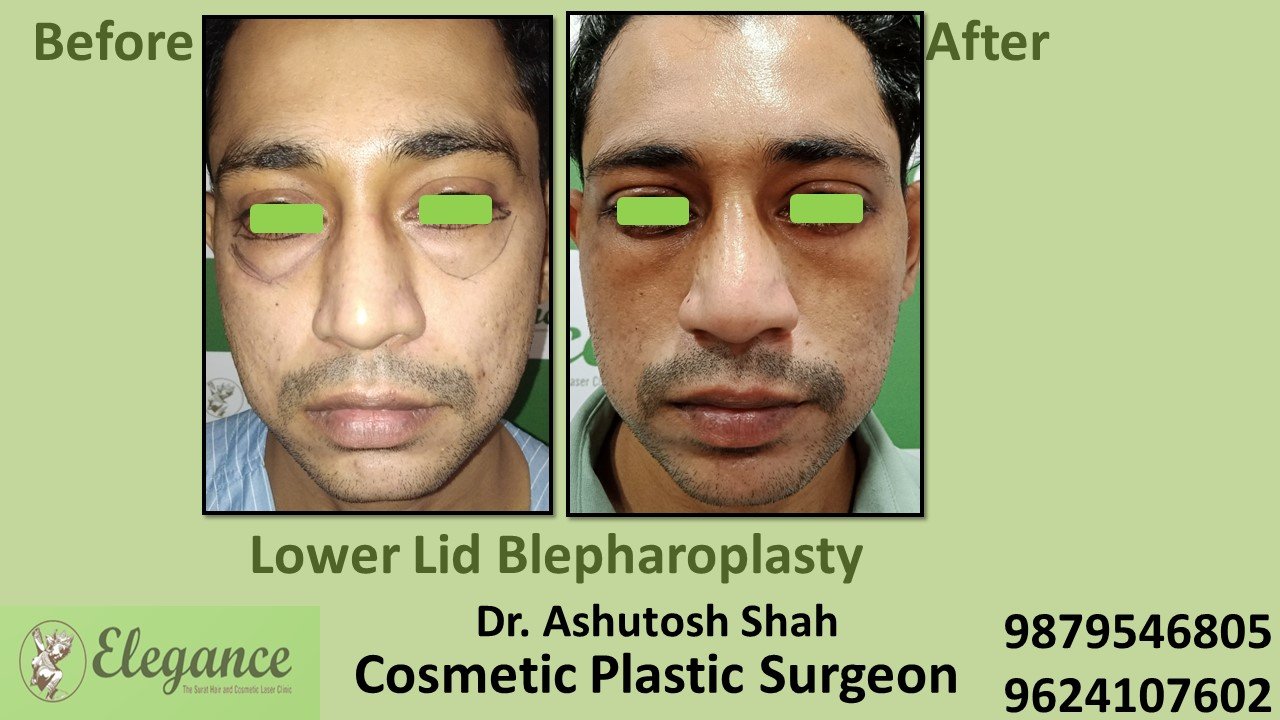 Blepharoplasty, Best Doctor For Under Eye Treatment In Surat, Navsari, Vapi.