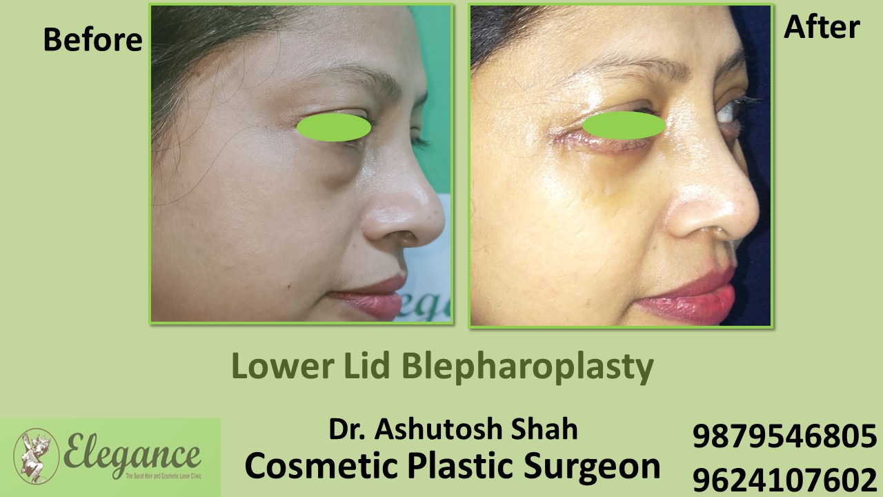 Blepharoplasty, Best Clinic For Under Eye Treatment In Surat, Bharuch, Valsad.