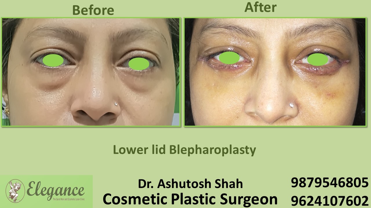 Blepharoplasty, Eye Bags Removal Treatment In Surat, Vapi, Bharuch.