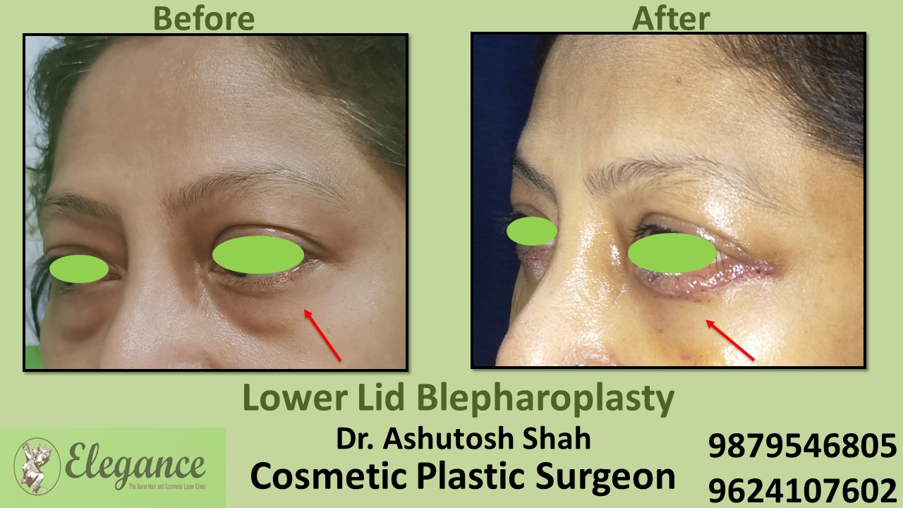 Blepharoplasty, Low Cost Eye Bags Treatment In Surat, Vapi, Bharuch.