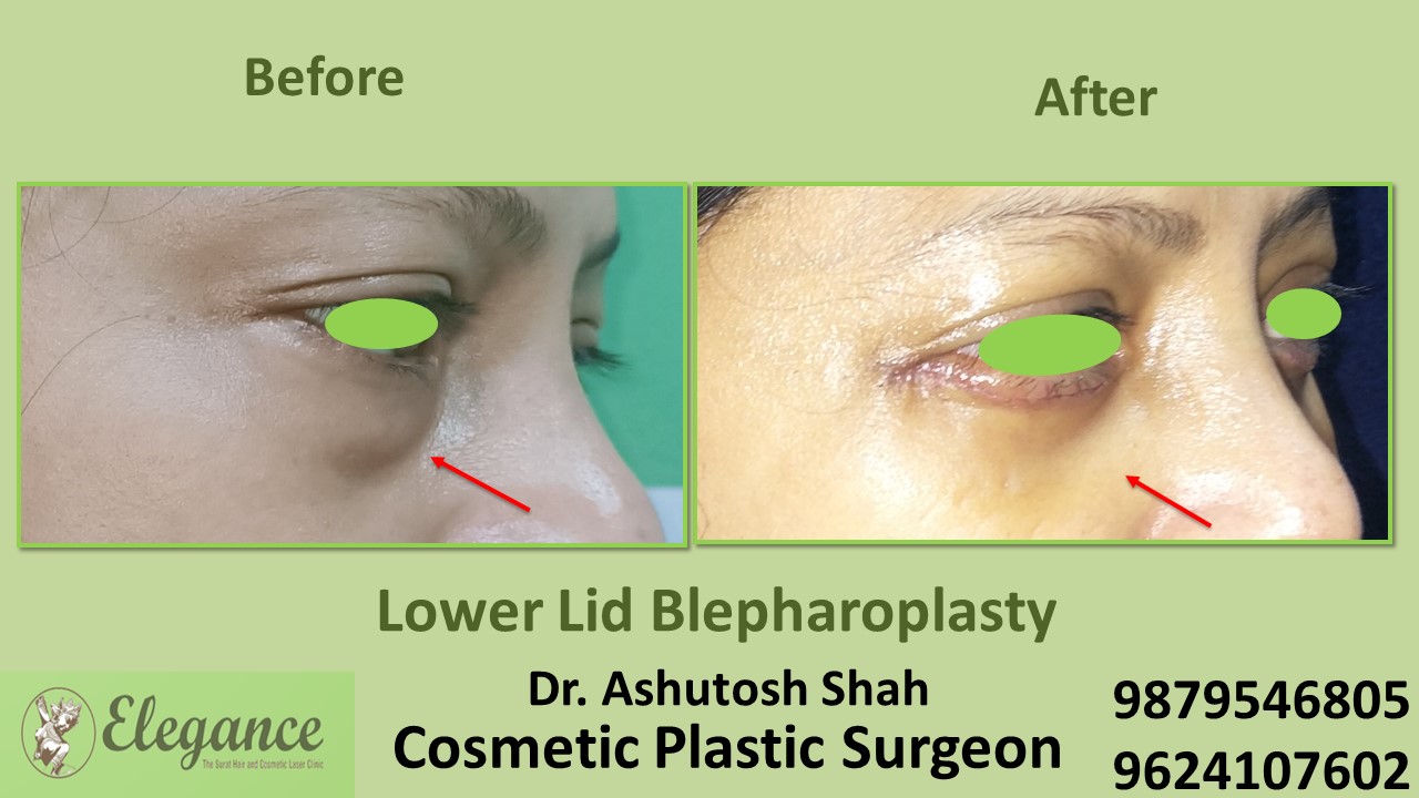 Blepharoplasty, Lower Eye Skin Treatment In Surat, Vapi, Bharuch.
