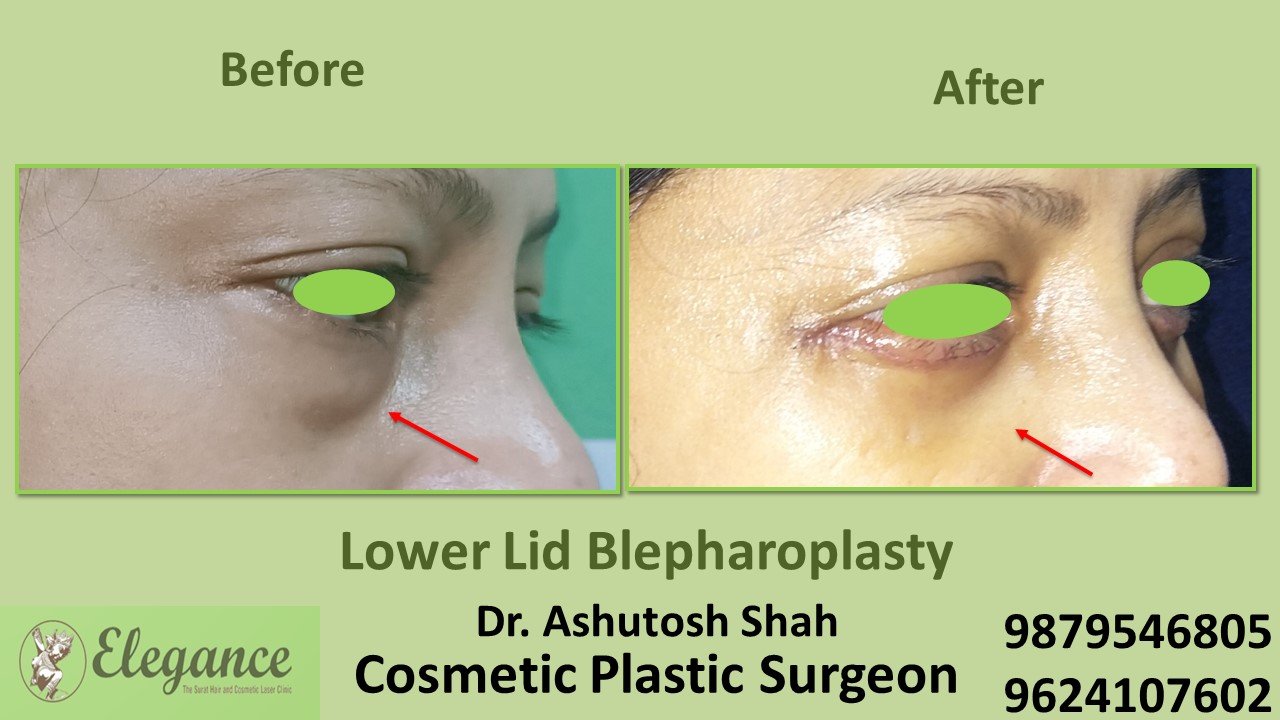 Blepharoplasty, Lower Eye Skin Treatment In Surat, Vapi, Bharuch.