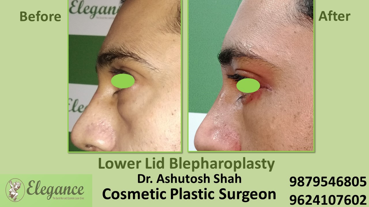 Blepharoplasty, Before And After Result for Eye Bags Treatment In Surat, Vapi, Bharuch.