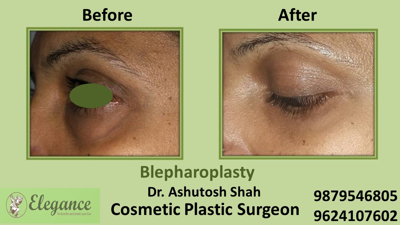 Blepharoplasty Treatment in Bharuch, Gujarat, India
