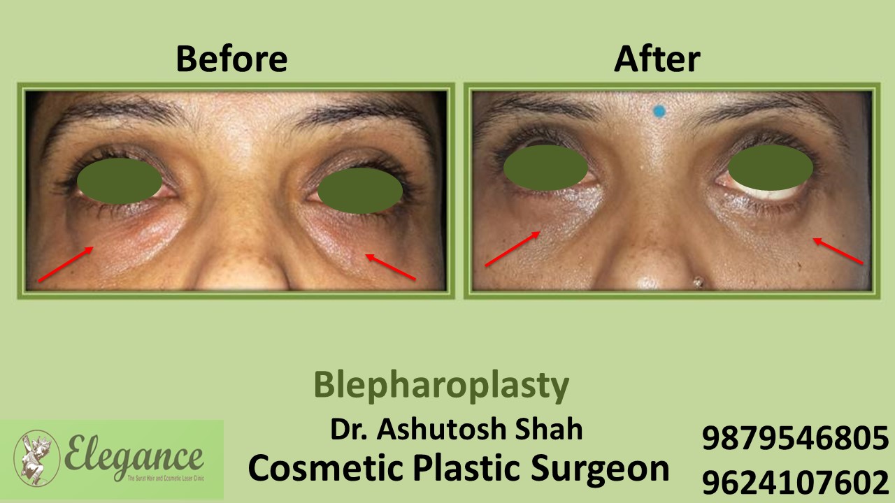 Blepharoplasty Treatment in Surat, Gujarat, India
