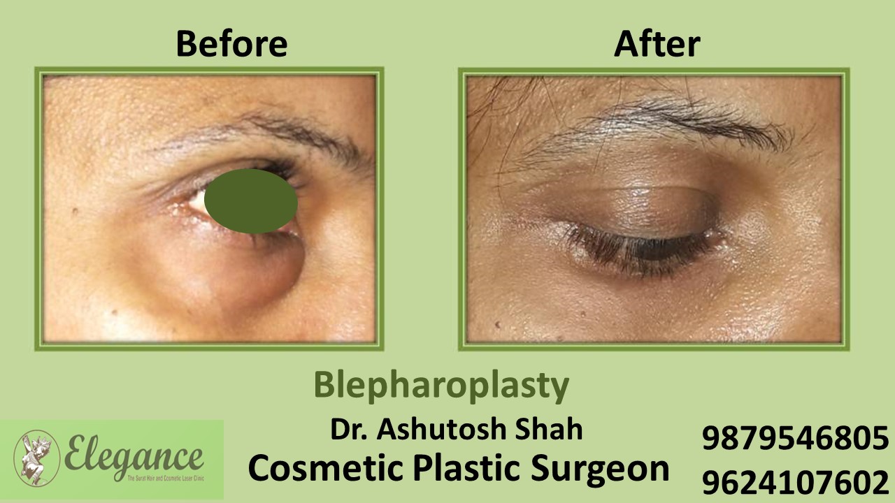Blepharoplasty Treatment in Valsad, Gujarat, India