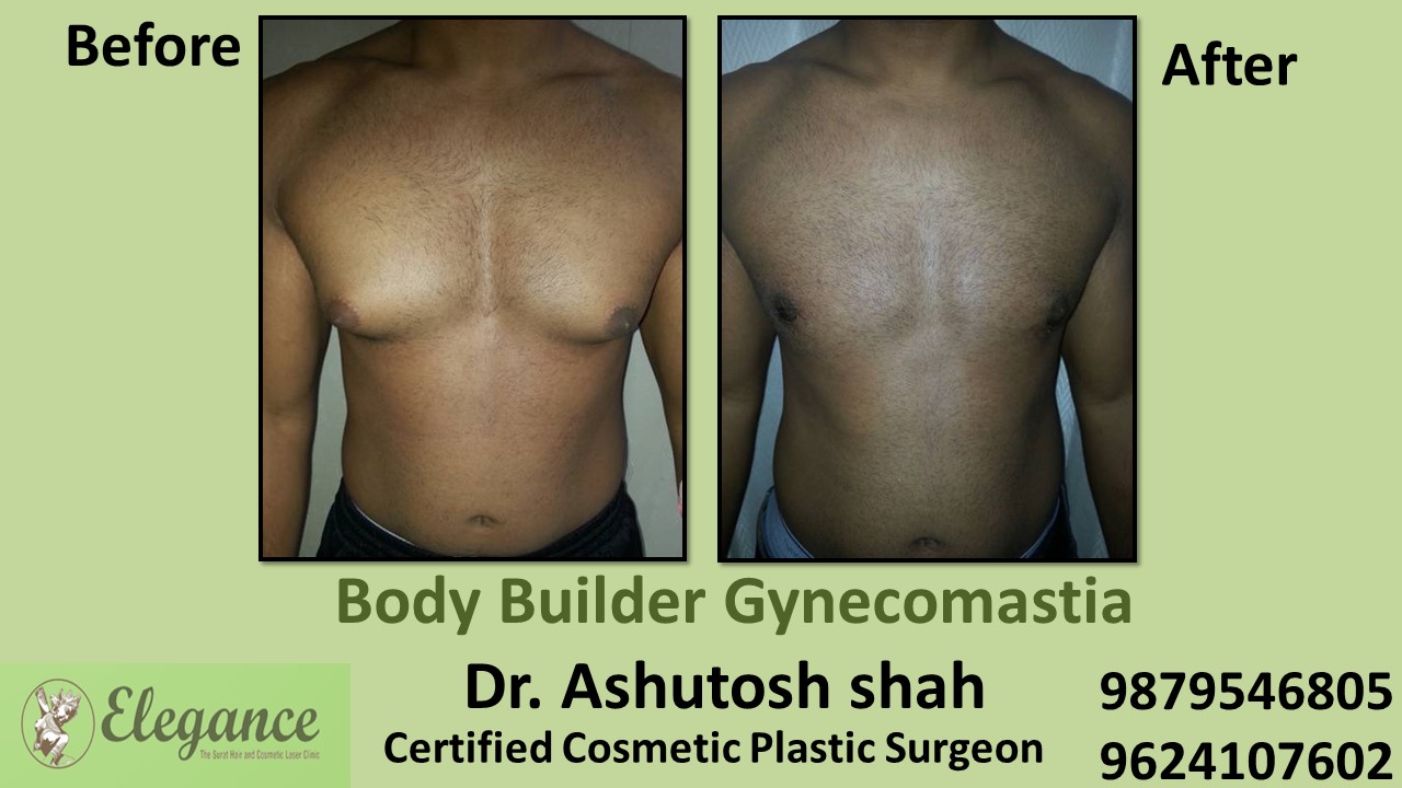 Body Builder- Gynecomastia Surgery in Surat