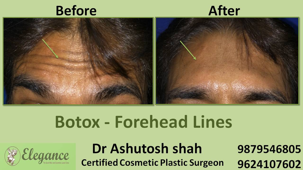 Horizontal Forehead Lines Treatment in Surat, Gujarat (India)