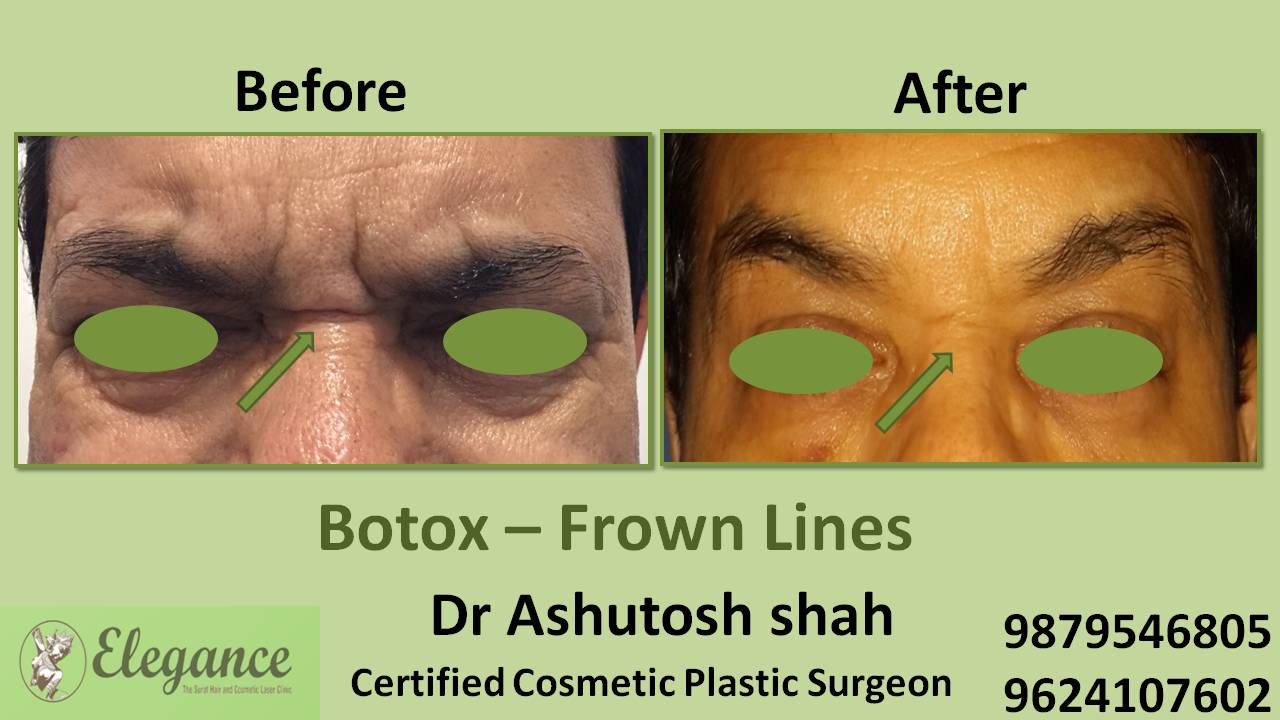 Frown Lines Fillers Treatment in Surat, Gujarat (India)