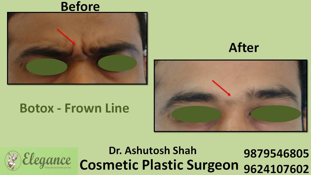 Glabellar Frown Lines Botox Treatment in Surat, Gujarat (India)