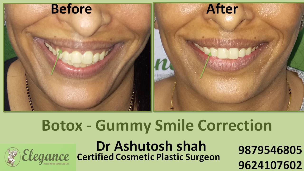 Gummy Smile Botox Treatment in Surat, Gujarat (India)