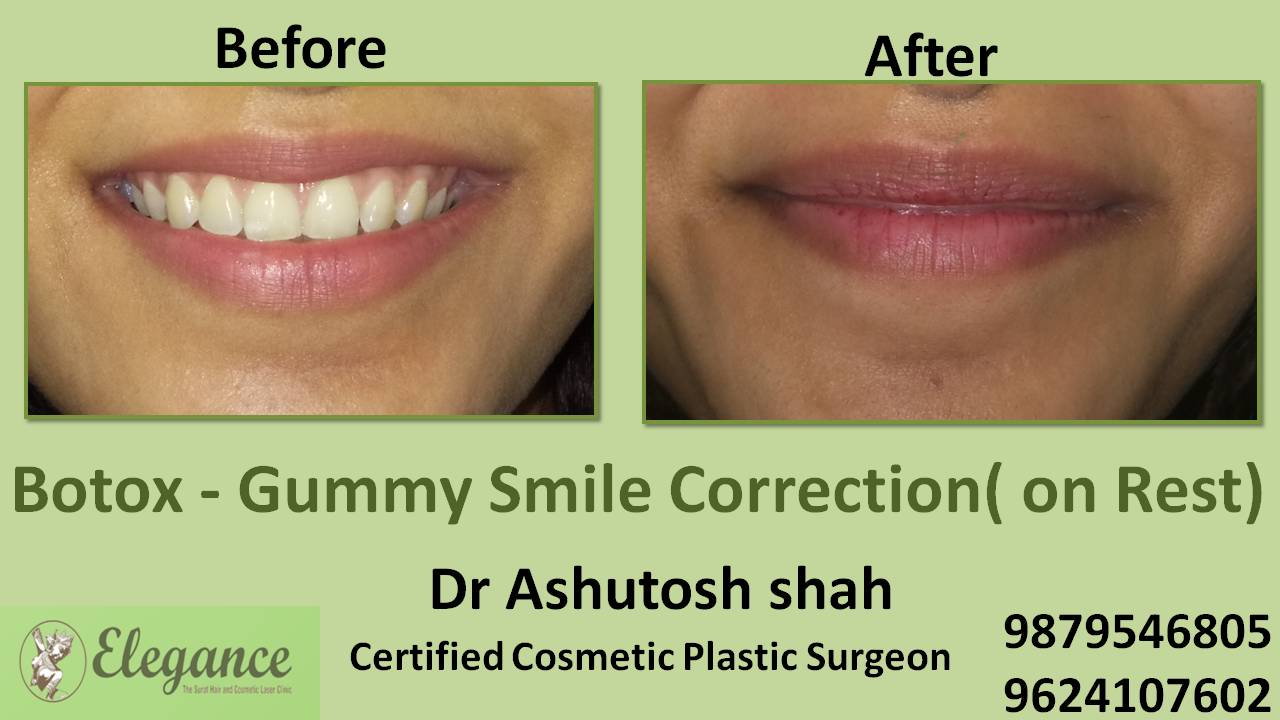 Gummy Smile Botox Treatment in Surat, Gujarat (India)