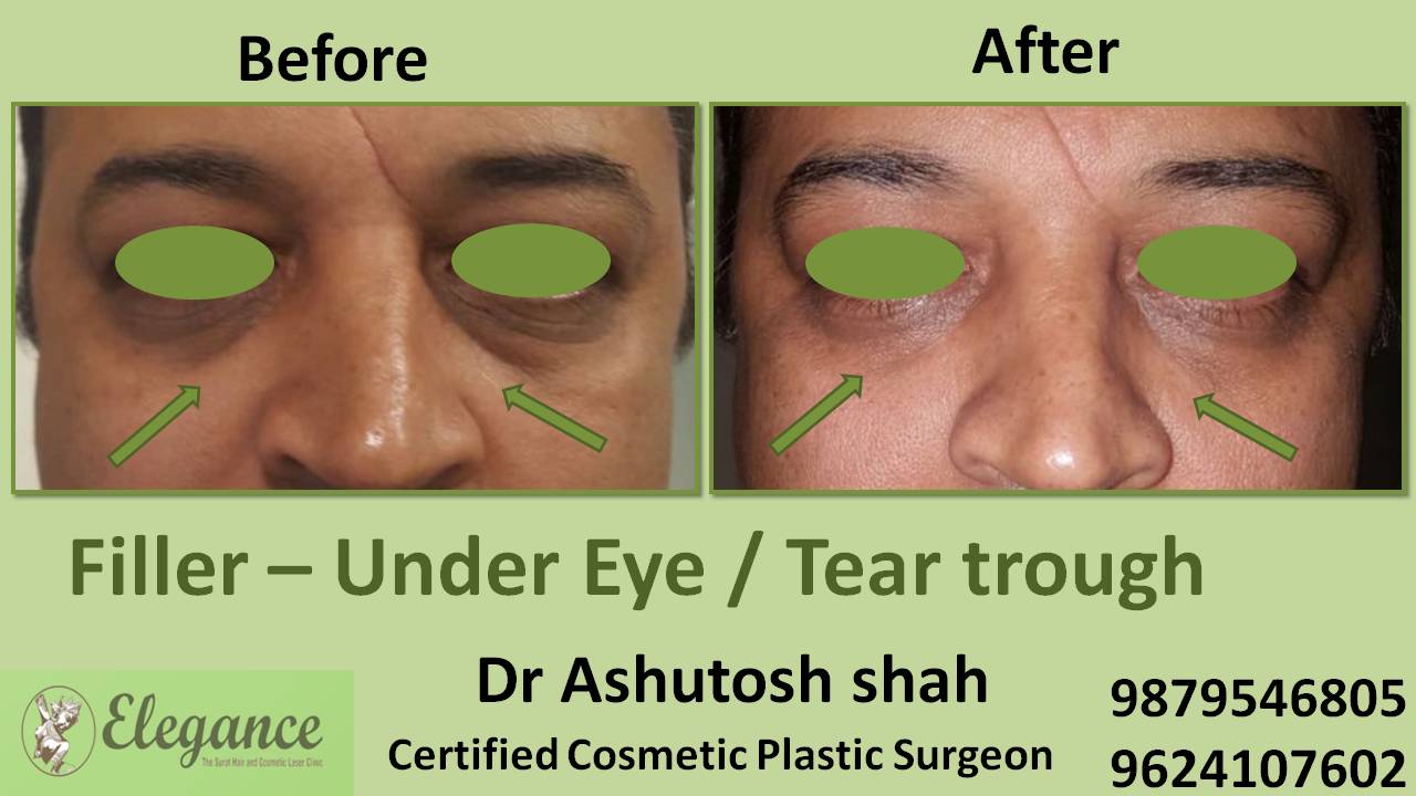Lower Eyelids Botox Treatment in Surat, Gujarat (India)