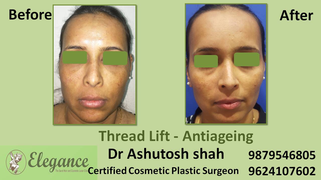 Face Lifting, Wrinkle Correction in Surat, Gujarat