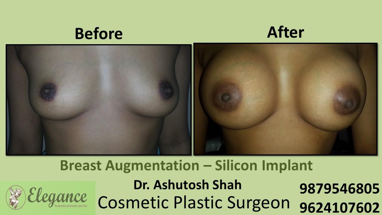 Breast Implants for Breast Augmentation in Surat, Gujarat (India)