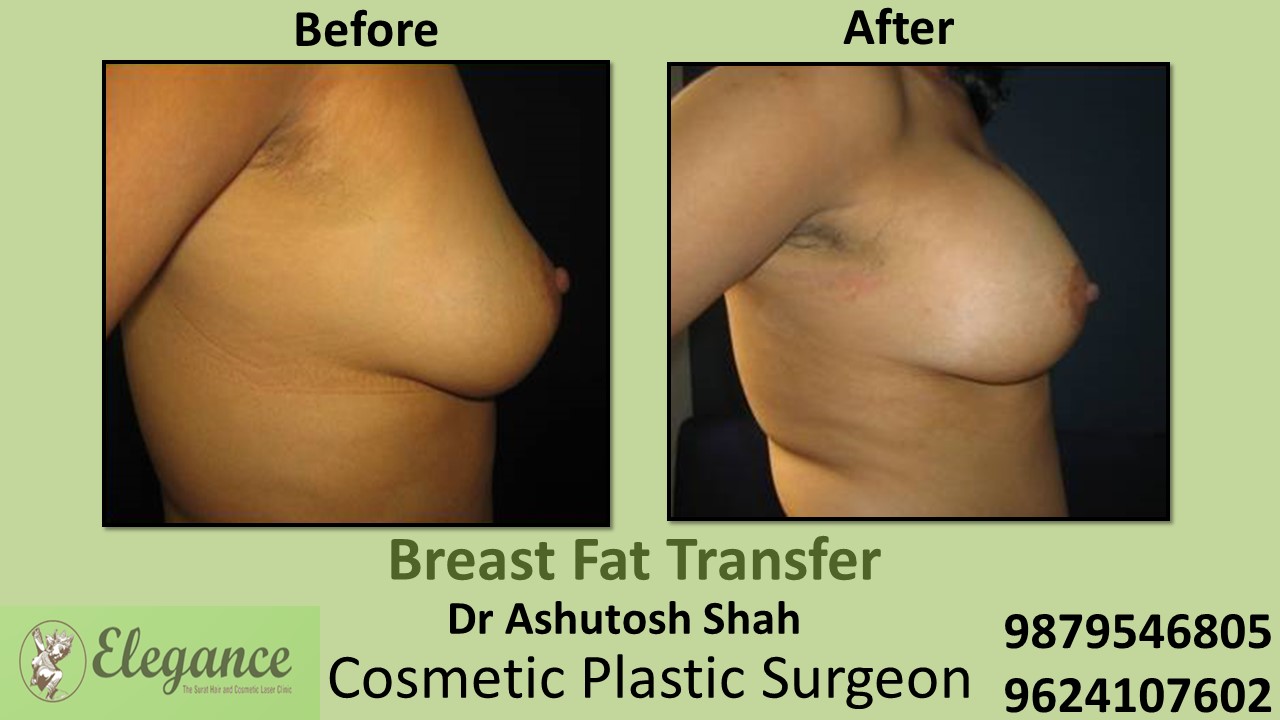 Breast Fat Transfer Surgery in Surat, Gujarat (India)
