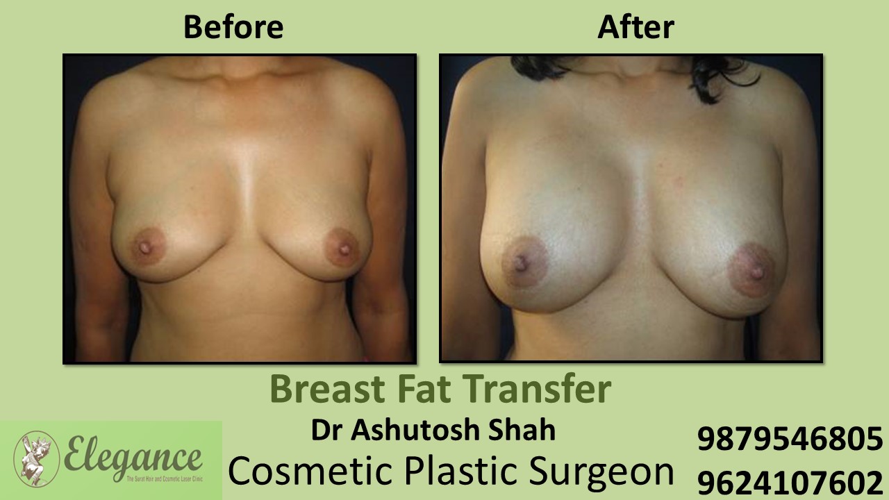 Breast Fat Transfer Surgery in Surat, Gujarat (India)