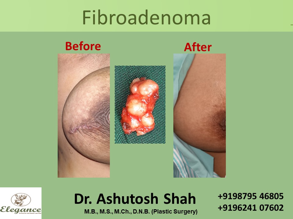 Breast Fibroadenoma Treatment in Surat, Gujarat (India)