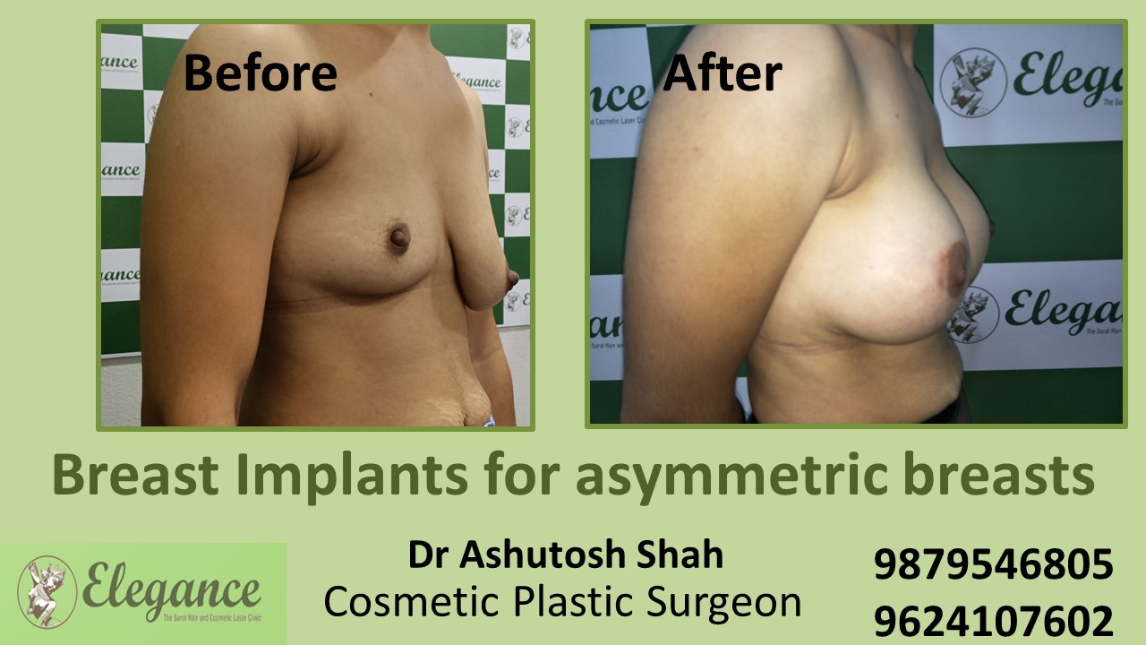 https://www.elegancegallery.in/cm-admin/uploads/image/breast-implant-surgery-vapi-gujarat-india.JPG
