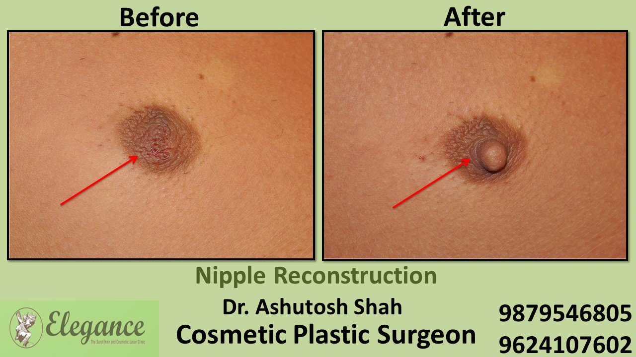 Breast Nipple Reconstruction Surgery in Surat, Gujarat (India)