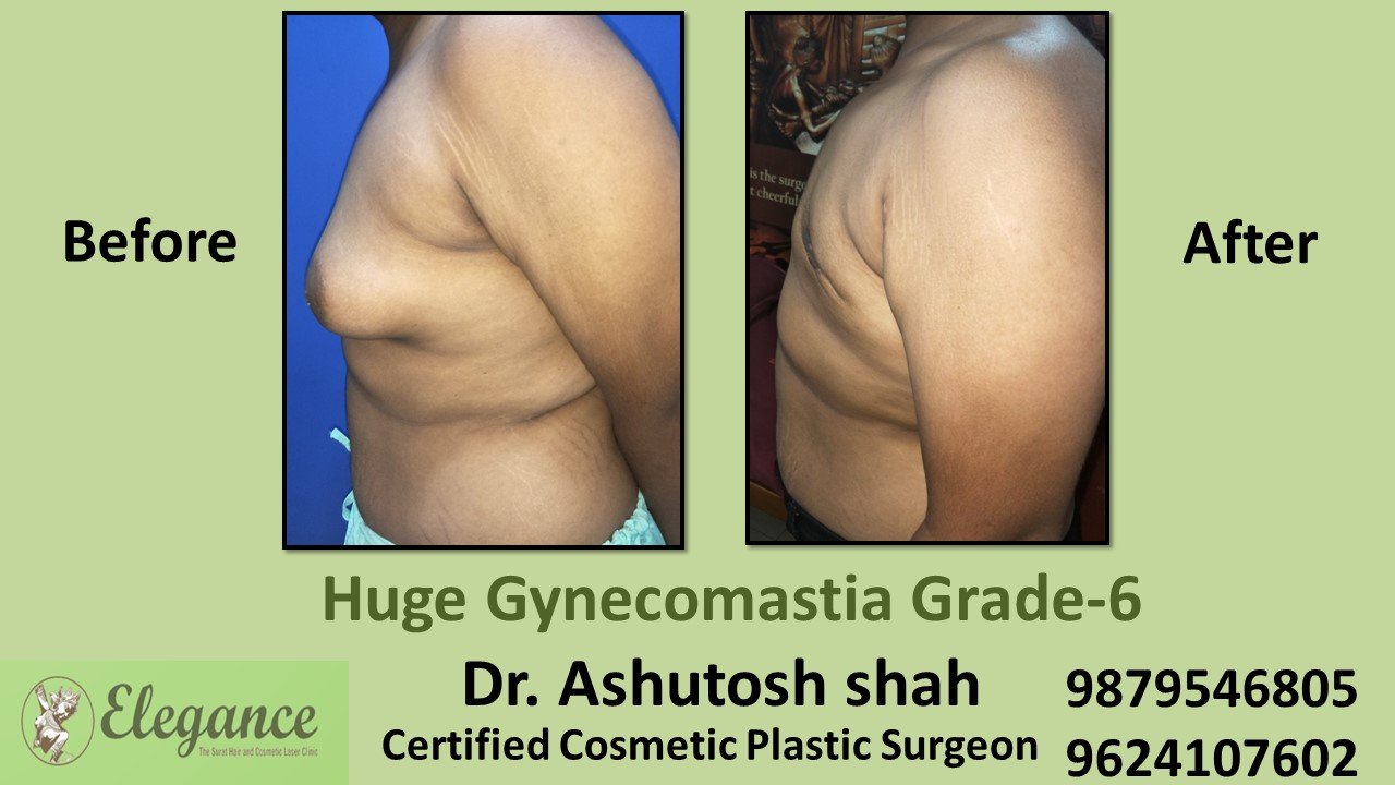 Breast Roll With Back Roll, Gynecomastia Grade-6, Kim, Gujarat, India.