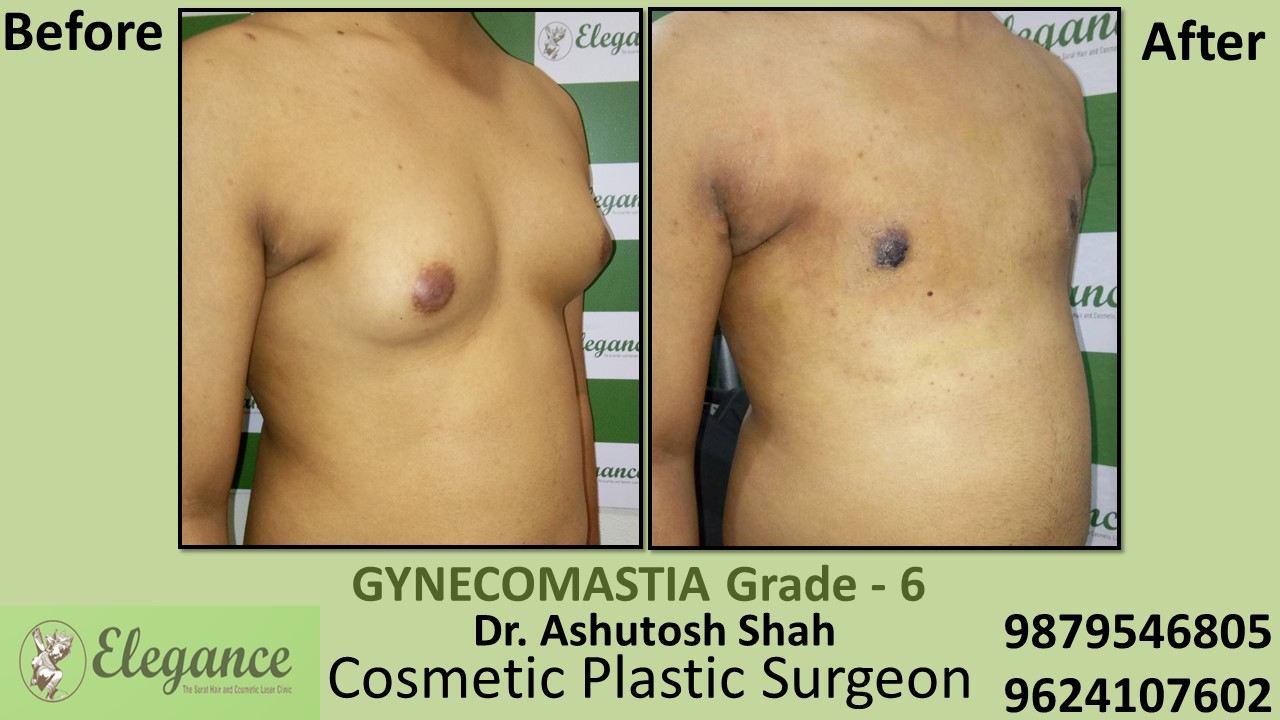 Breast Roll With Back Roll Gynecomastia Grade-6 Surgery, Surat, Gujarat, India.