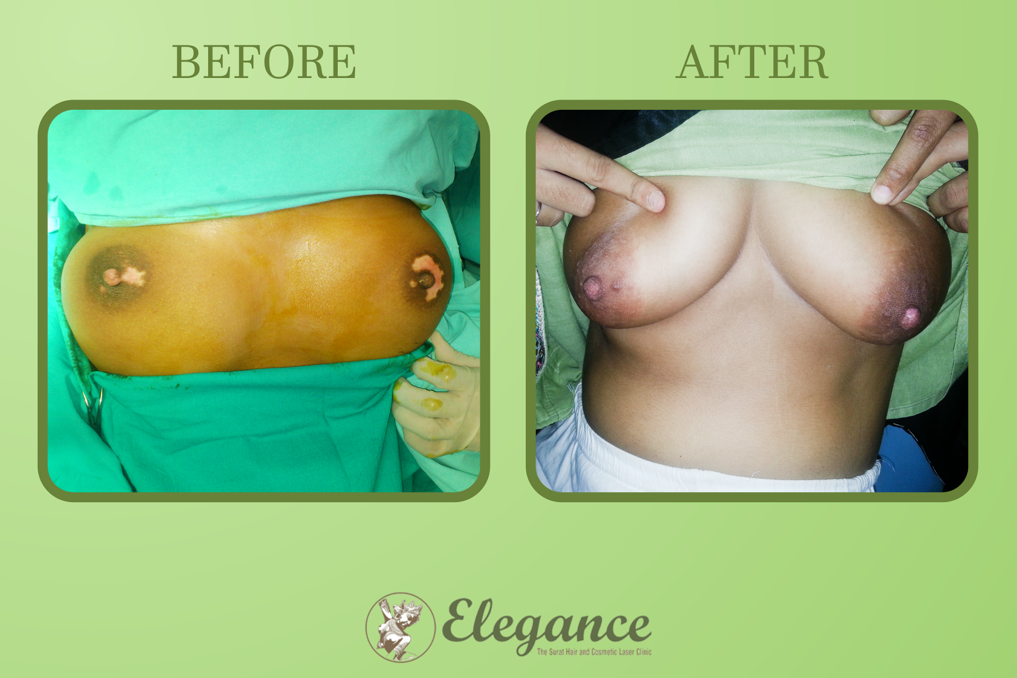 Vitiligo Surgery For Breast in Surat, Gujarat (India)