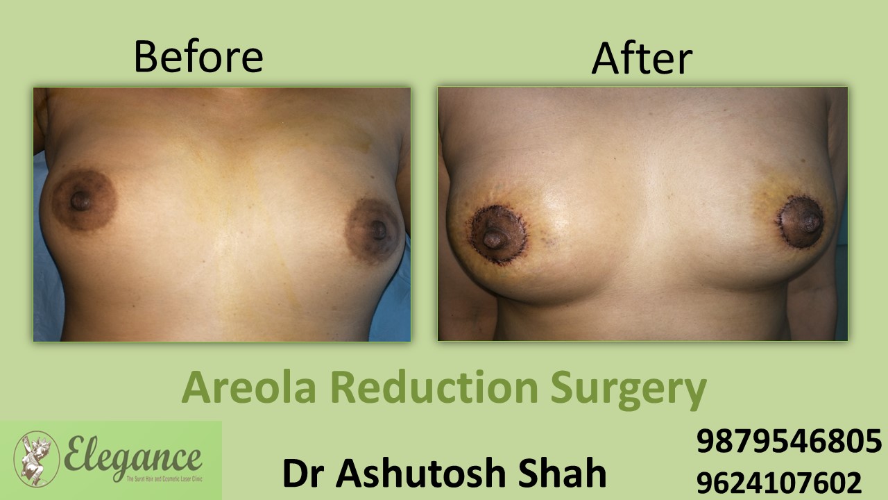 Areola Reduction Breast Surgery in Surat, Gujarat (India)