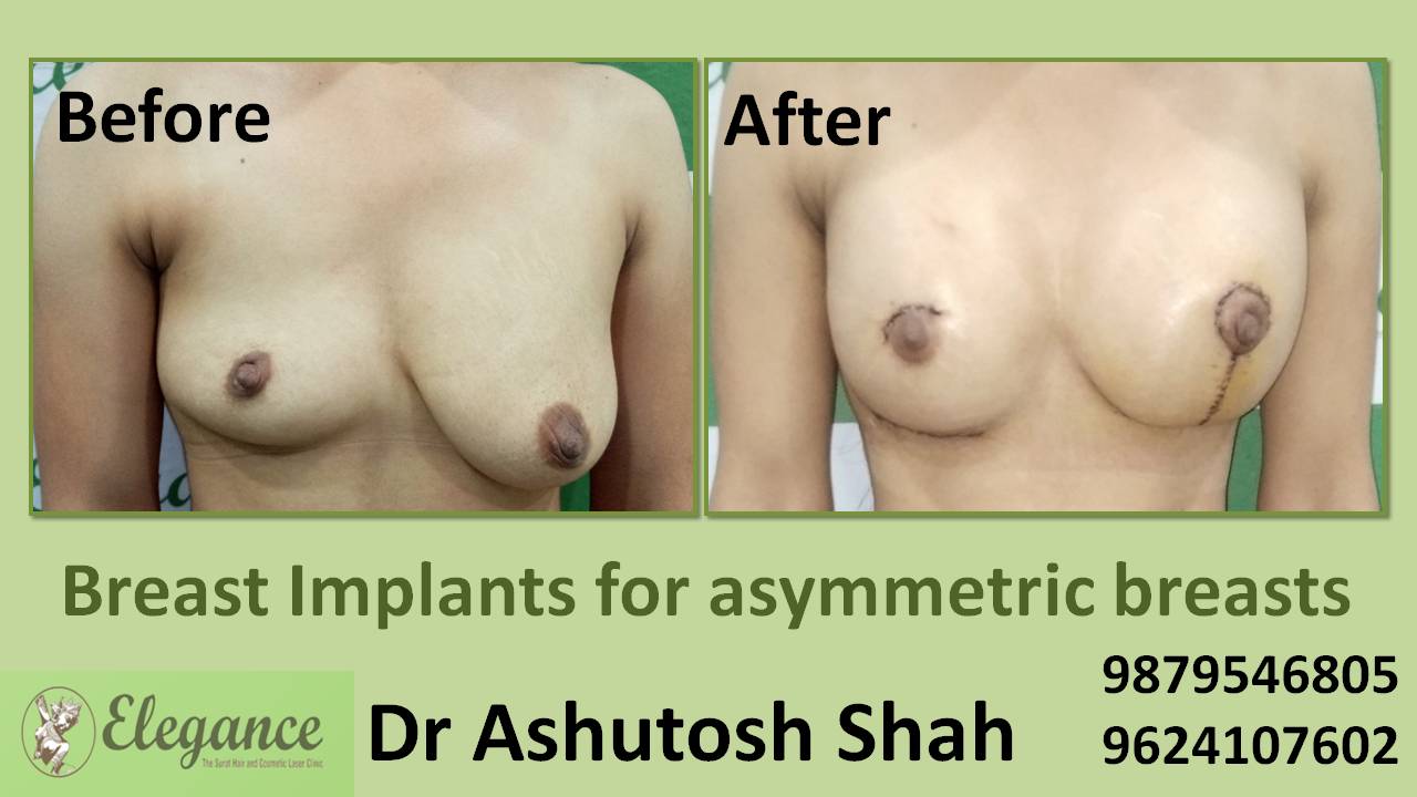 Breast Surgery to Correct Asymmetry​ (Corrective Surgery) in Surat, Gujarat (India)