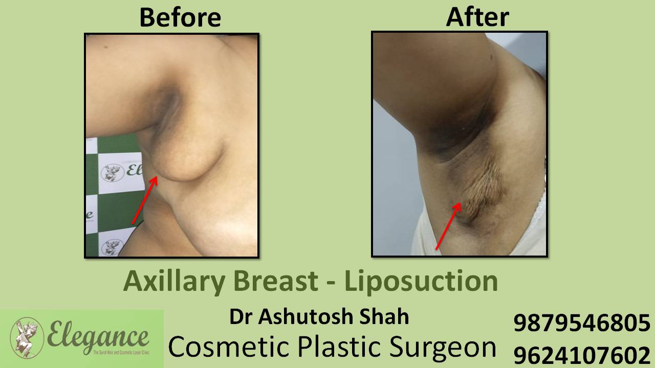 Axillary Breast Surgery in Surat, Gujarat (India)