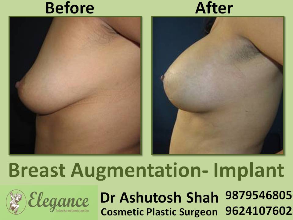 Breast Augmentation​ Surgery in Surat, Gujarat (India)