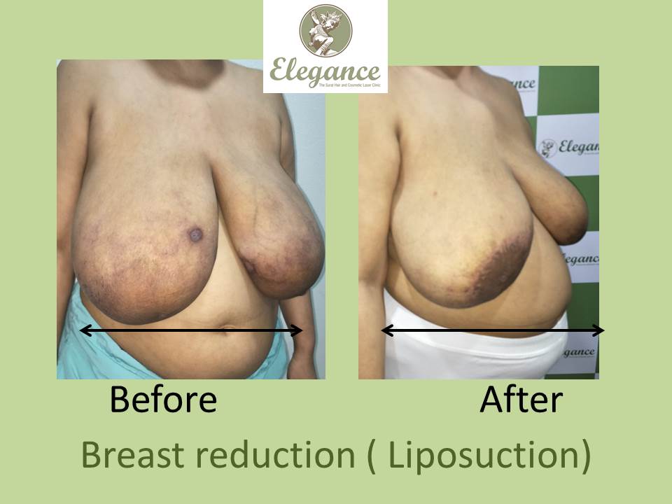 Breast Liposuction Surgery in Surat, Gujarat (India)