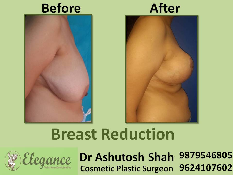 Breast Reduction Surgery in Surat for Unmarried Girls, Gujarat (India)