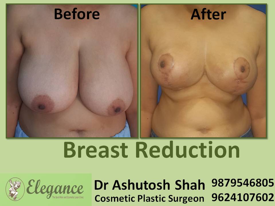 Breast Reduction Surgery in Surat for Unmarried Girls, Gujarat (India)