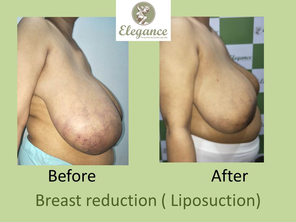 Breast Liposuction Surgery in Surat, Gujarat (India)