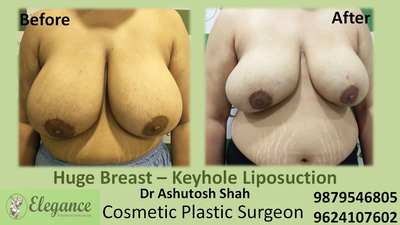 Keyhole Breast Reduction Treatment in Surat, Gujarat (India)