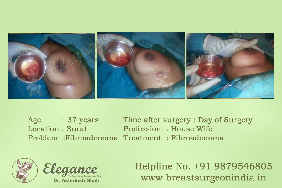 Breast Fibroadenoma Treatment in Surat, Gujarat (India)
