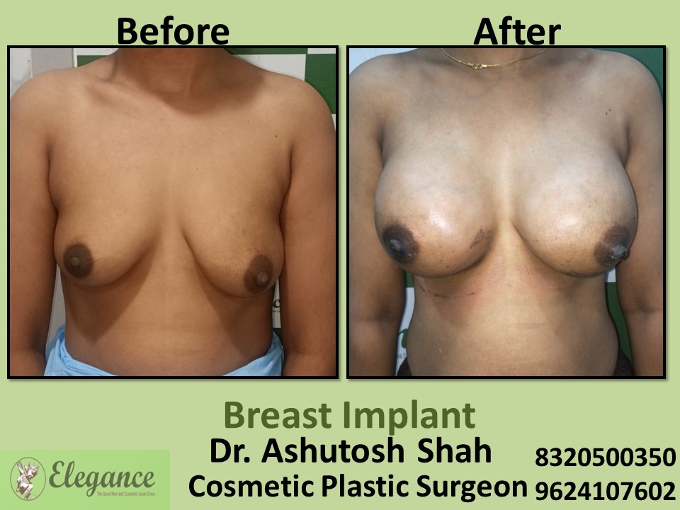 Saggy Breast, Breast Correction, Breast Implant in Vesu, Piplod, Surat