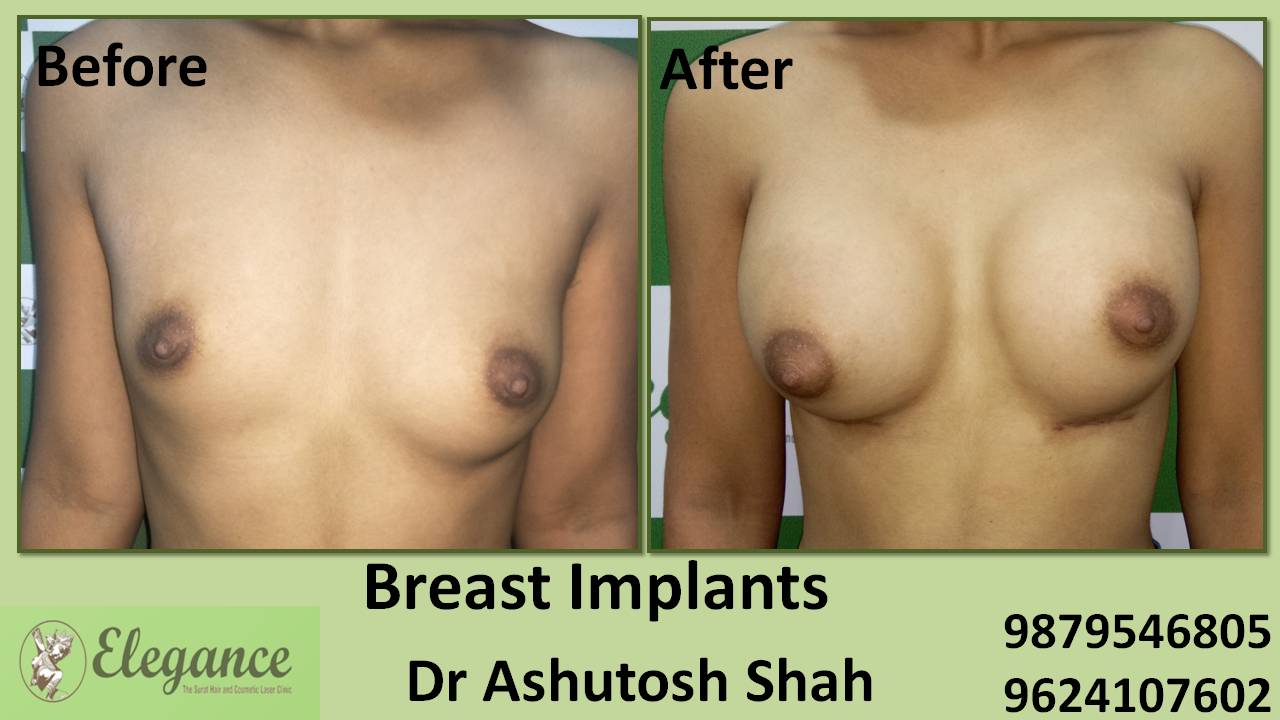 Breast Implant Surgery in Surat, Gujarat (India)