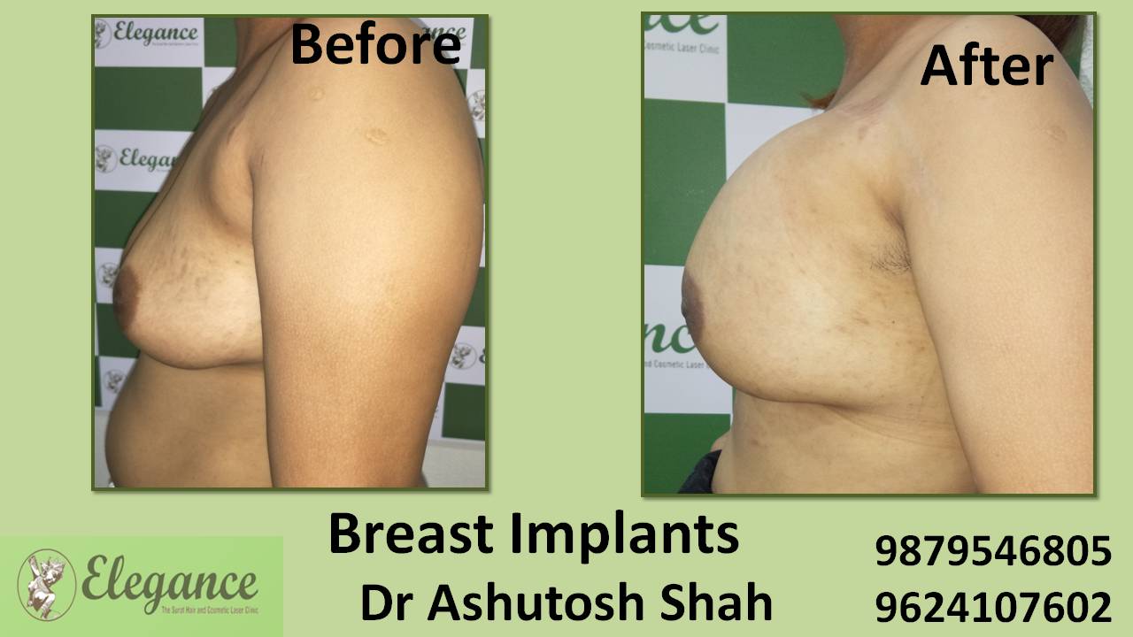 Breast Implant Surgery in Surat, Gujarat (India)