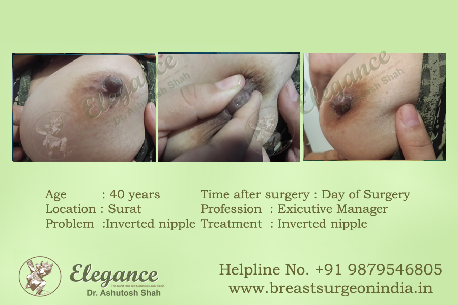 Breast Inverted Nipple Correction Surgery in Surat, Gujarat (India)