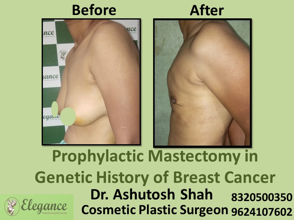 Breast Tumor | Breast Removal Surgery in Surat