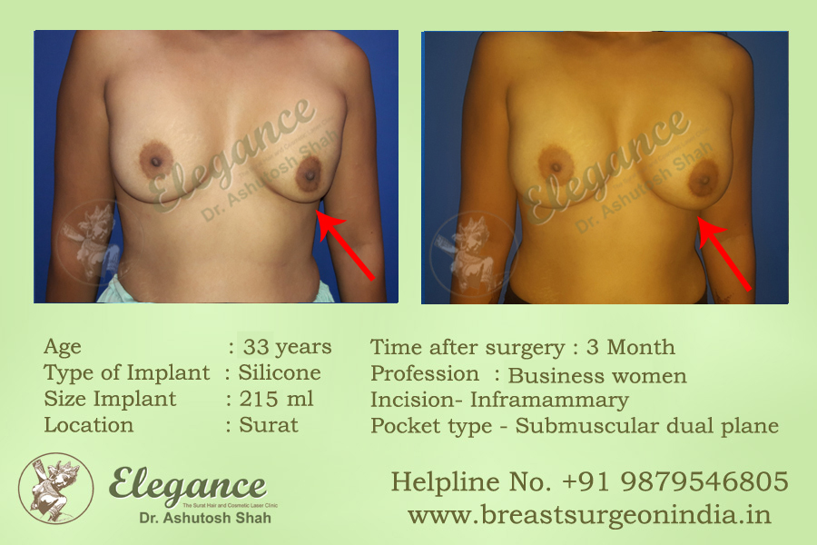 Breast Revisional Surgery​ in Surat, Gujarat (India)
